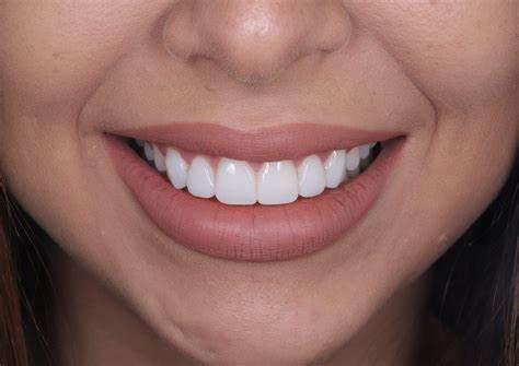 Teeth Whitening